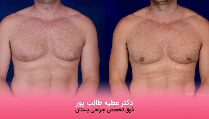 درمان غیر جراحی ژنیکوماستی