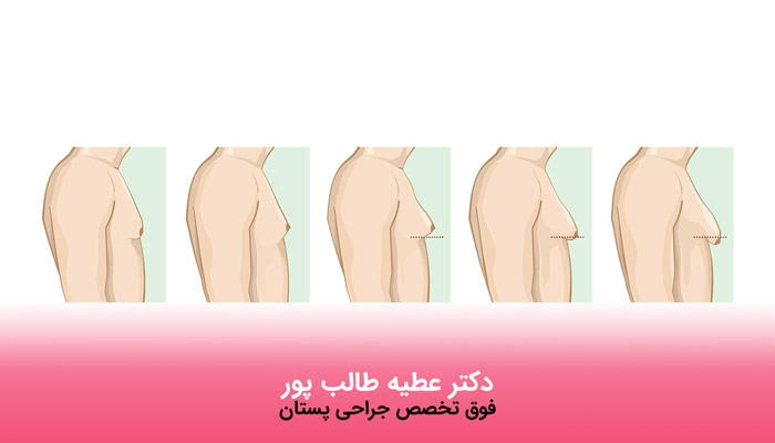 دلایل بروز ژنیکوماستی