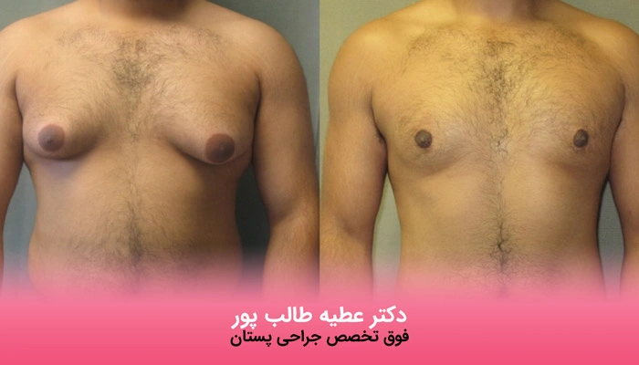 درمان جراحی ژنیکوماستی