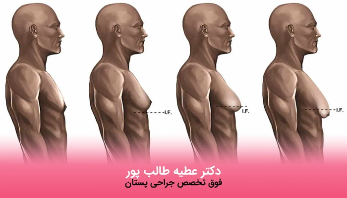 علائم ژنیکوماستی