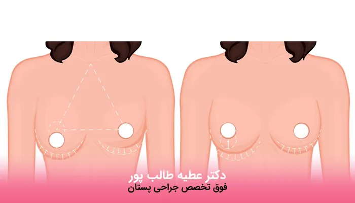 مزایای جراحی اصلاح عدم تقارن پستان