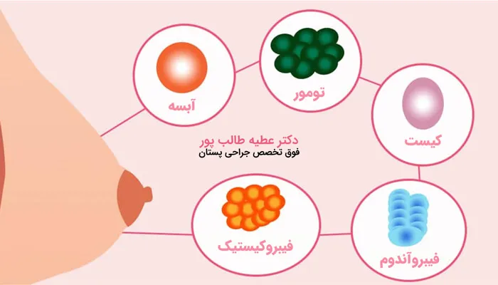 انواع توده خوش خیم پستان