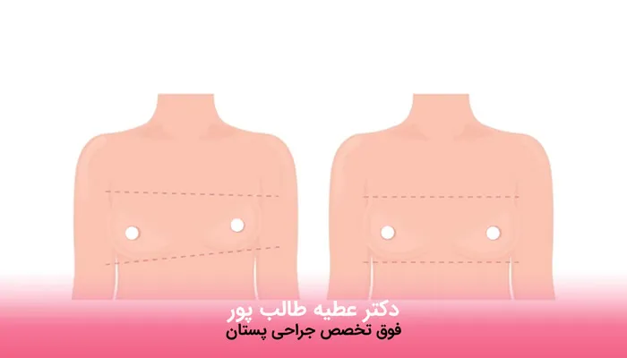 مراحل عمل اصلاح عدم تقارن سینه