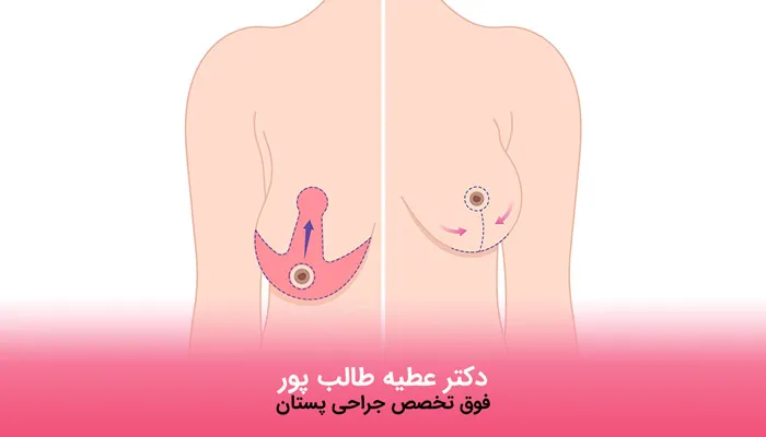 انواع ماموپلاستی