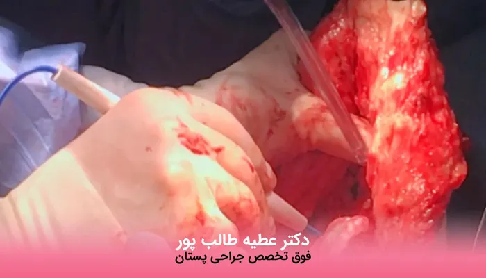 نمونه عمل ماموپلاستی