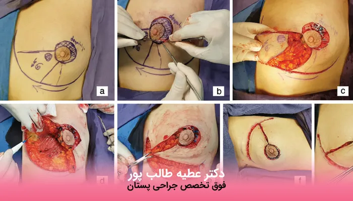 مراحل جراحی ماموپلاستی