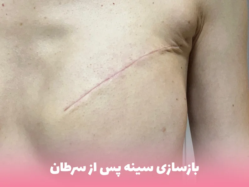 جراحی بازسازی پستان