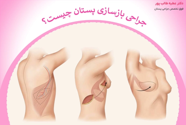 جراحی بازسازی پستان